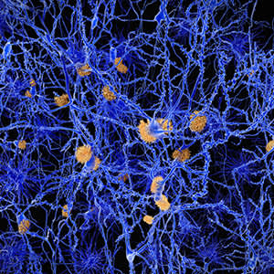 斑块和缠结在阿尔茨海默病患者形象的大脑。