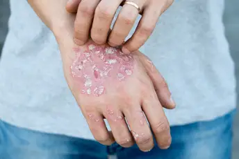 牛皮癣的男人抓了他的手。