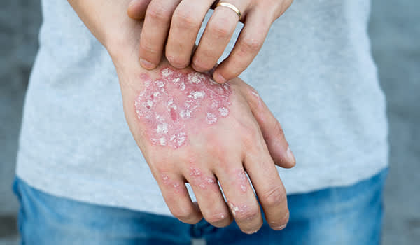 患有牛皮癣的男子抓手。