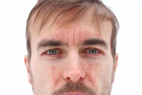 A closeup of psoriasis on a man’s face