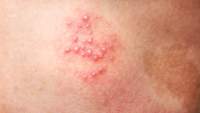 带状疱疹溃疡
