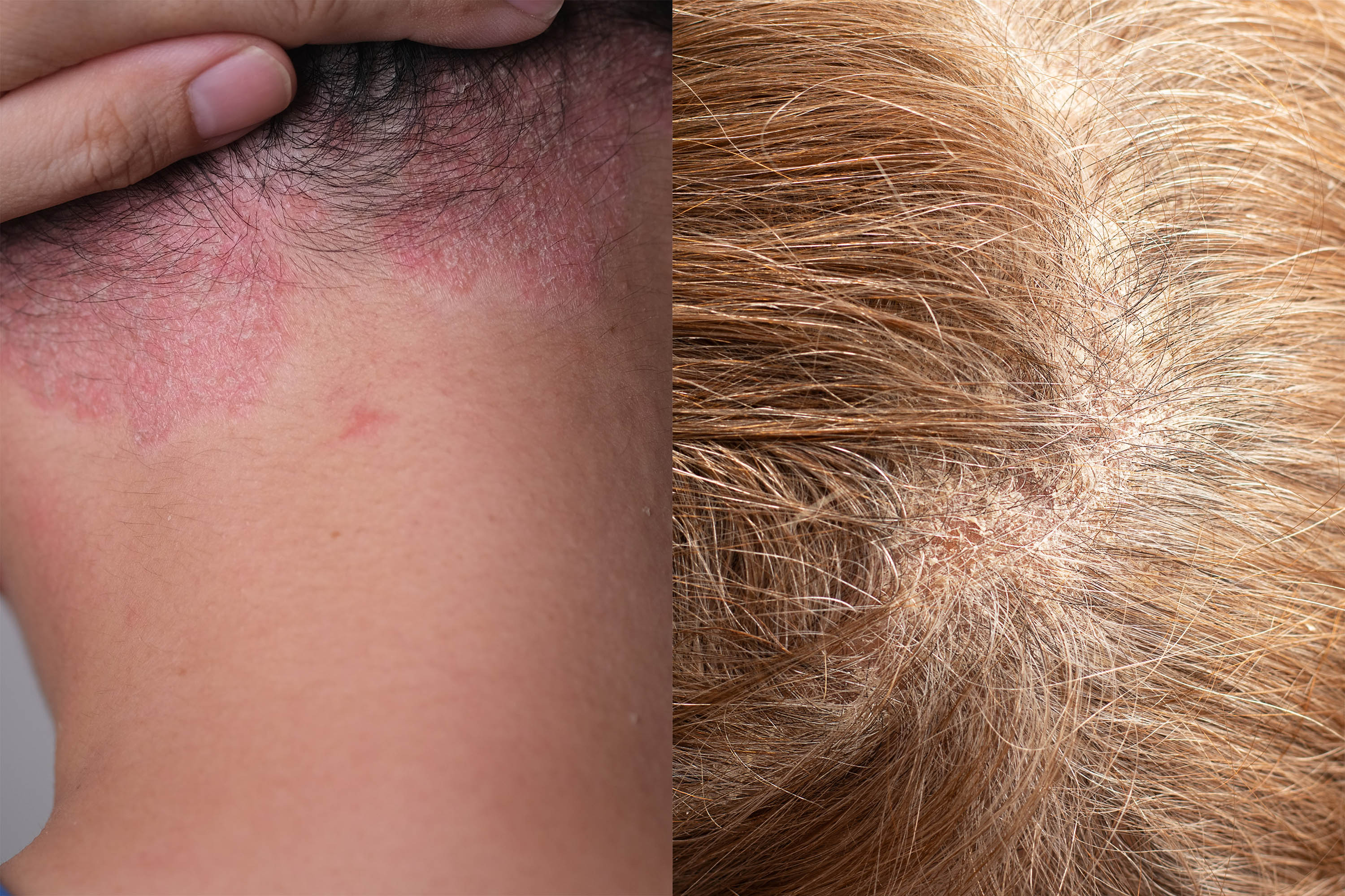 Scalp Psoriasis vs. Scalp Eczema: How to Tell the Difference