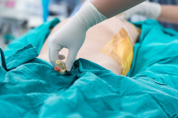 为病人做膀胱手术。