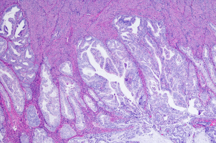 子宫内膜腺癌显微照片