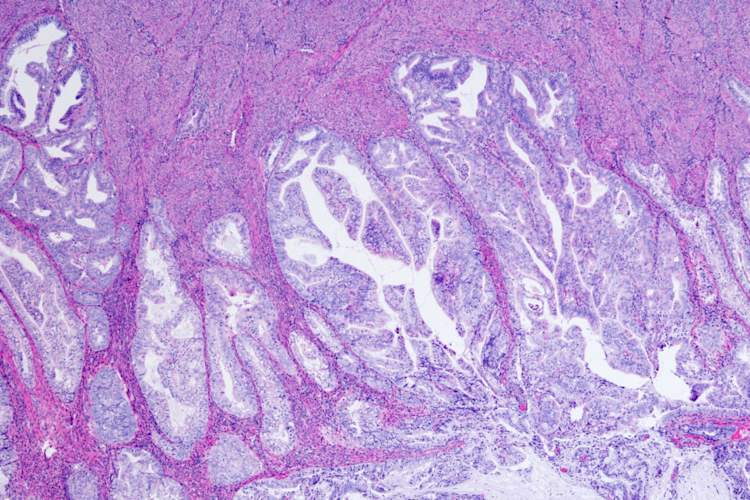 子宫内膜腺癌显微照片