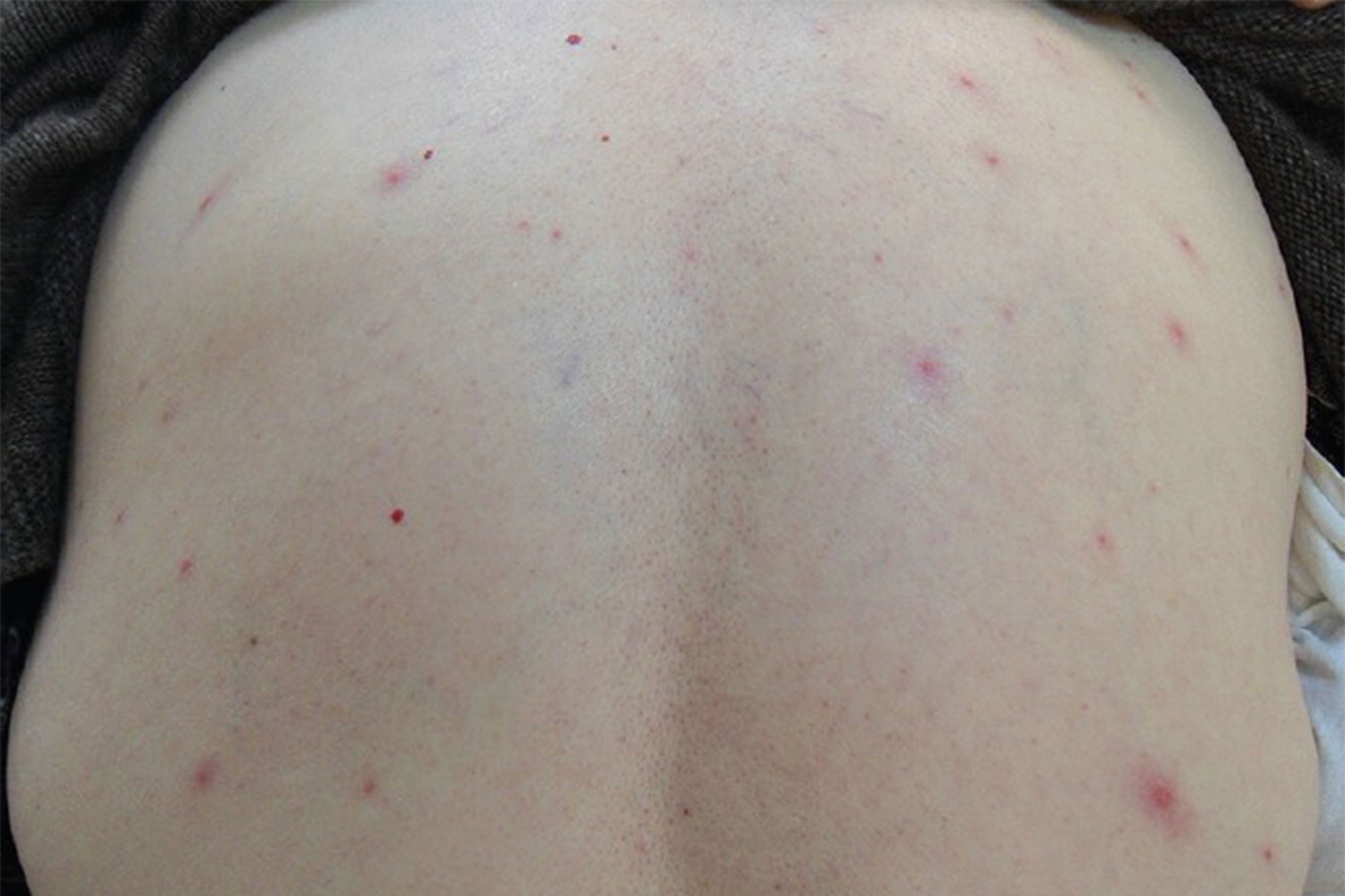Chemotherapy Effects On Skin