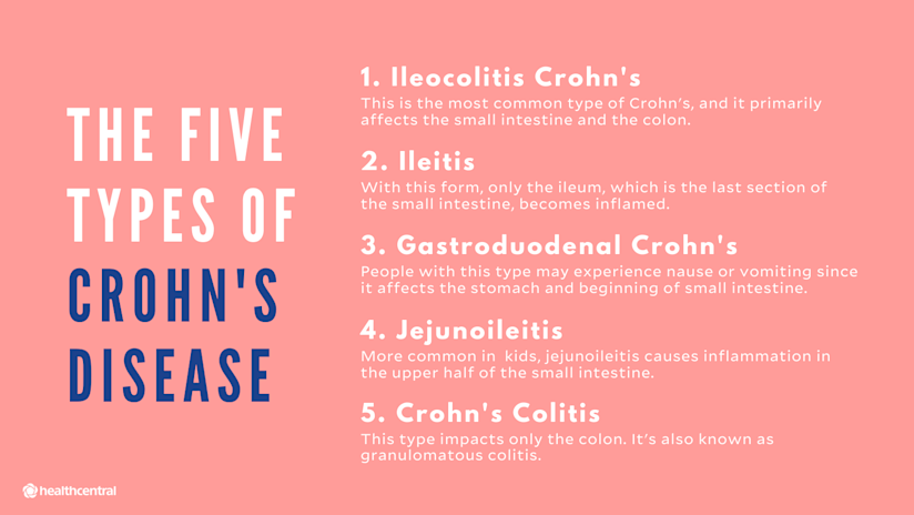 克罗恩病的五种类型:回肠炎、回肠炎、胃十二指肠克罗恩病、空肠回肠炎、克罗恩结肠炎