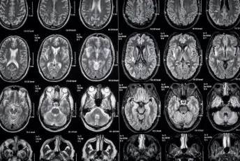 脑MRI