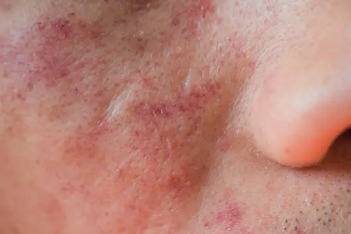 脸颊上有粉刺样的肿块