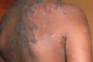 A view of infected eczema on a back