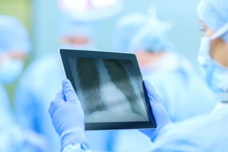 肺癌手术:老年患者的胜算更大