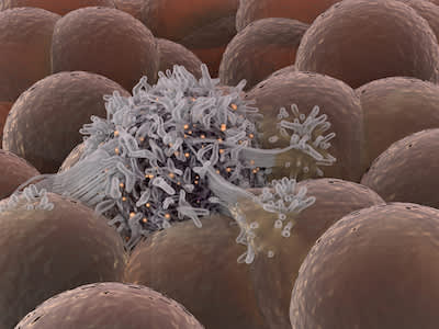 健康细胞中的恶性癌细胞。