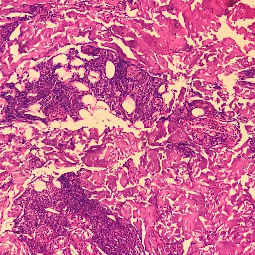 麻风病的组织病理学