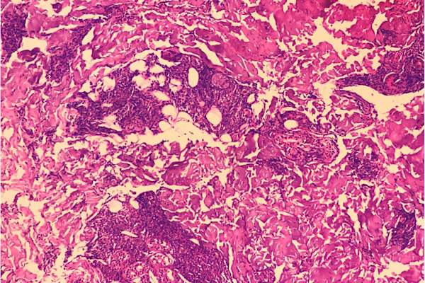 麻风病理组织学