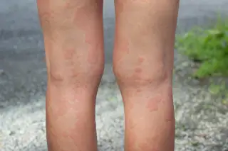 mild heat rash legs