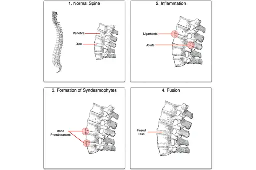 通过Senseiwa制造的强直性过程，带有灰色解剖结构的脊柱图像