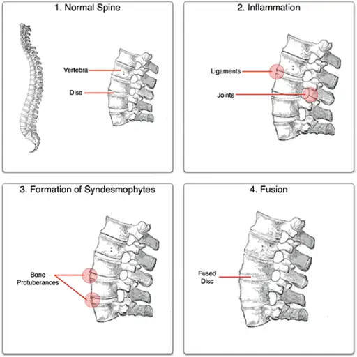 僵直过程，由Senseiwa制作，结合格雷解剖中的脊柱图像