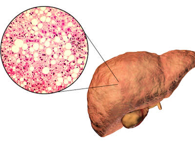 脂肪肝细胞特写。