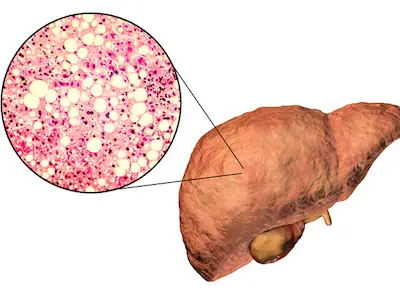 一个带有细胞的脂肪肝。