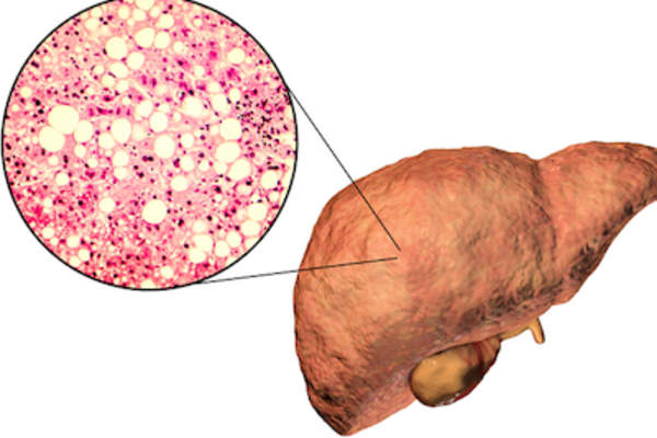脂肪肝细胞特写。