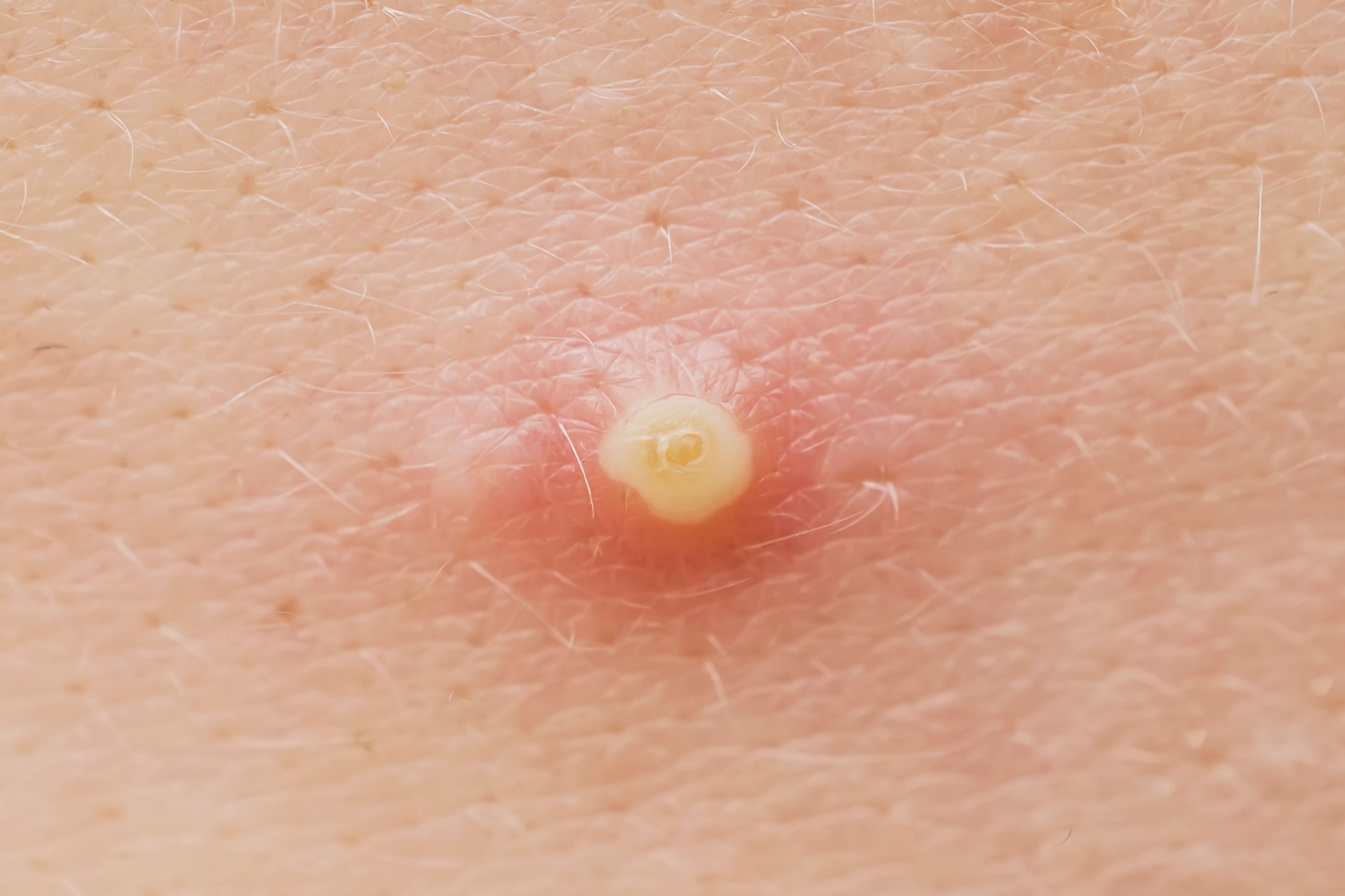 Pimple on Nipple: Causes, Symptoms and Treatment