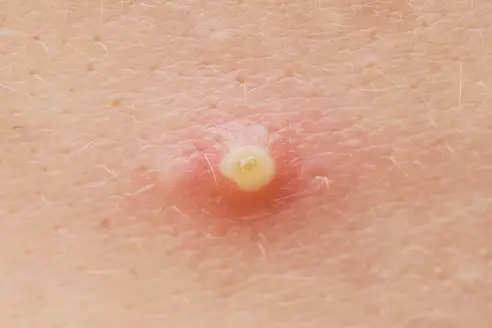 Pimple on Nipple: Causes, Symptoms and Treatment