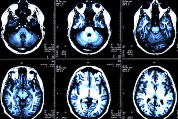 核磁共振大脑扫描。