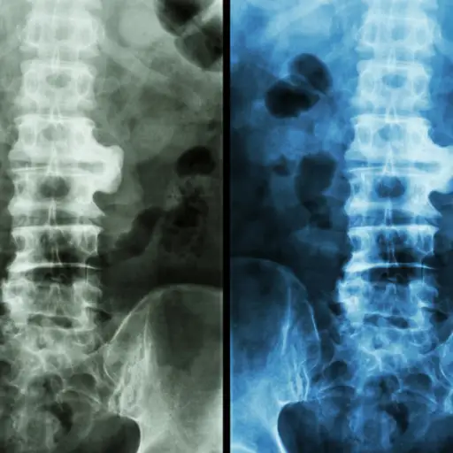在X射线上看到的脊柱病