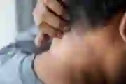 Man touching a psoriasis plaque on the back of his neck