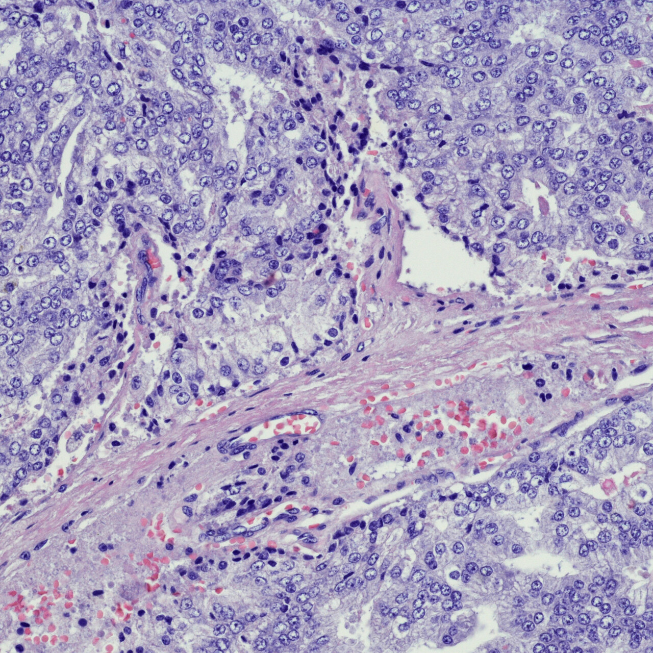 转移性前列腺癌的显微照片