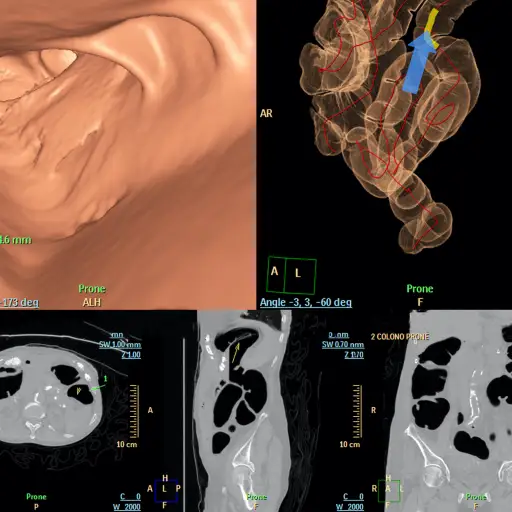CT扫描结肠