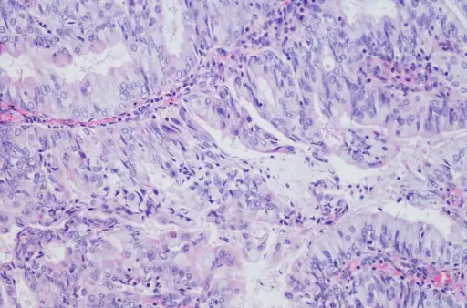 子宫内膜腺癌的显微照片