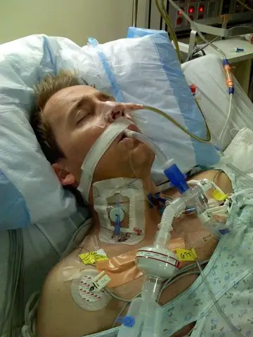 史蒂夫·梅伦用呼吸管呼吸。