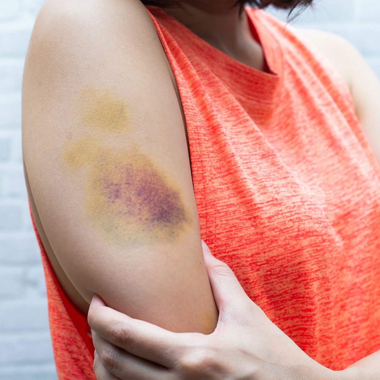 看到一个女人的受伤的手臂