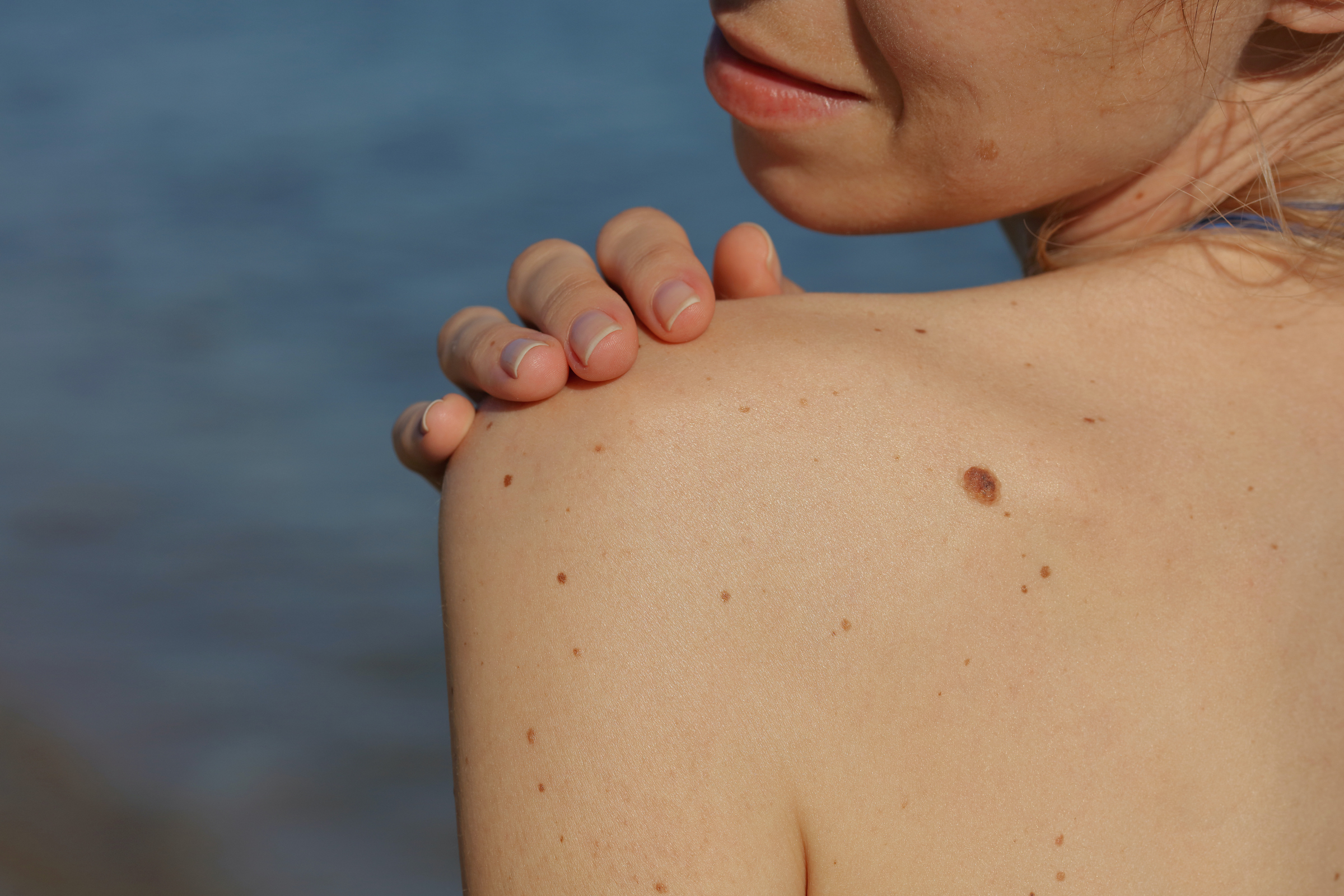 Melanoma Warning Signs 6 Steps to Spot Skin Cancer Early