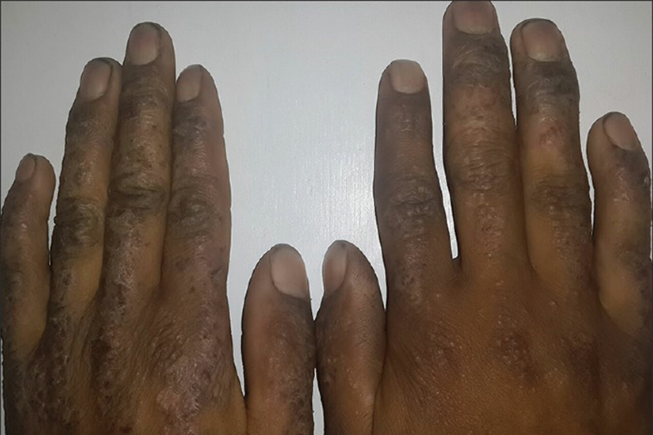 What Causes Eczema On Your Hands And How To Treat It - Bodewell