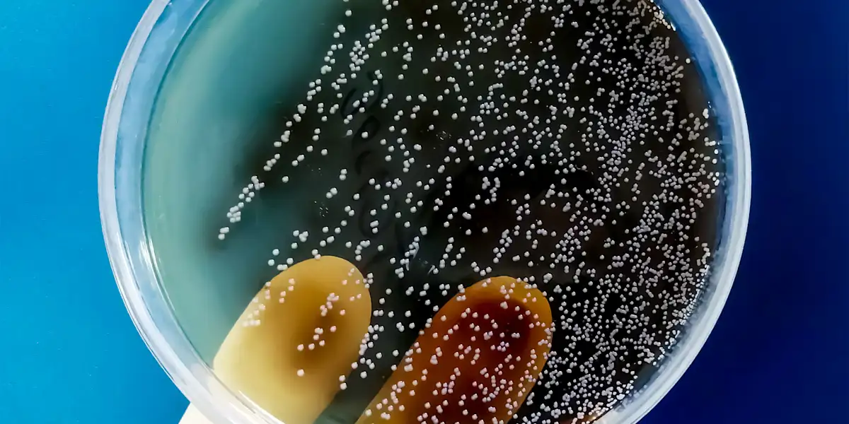 Can a Yeast Infection Delay Your Period?