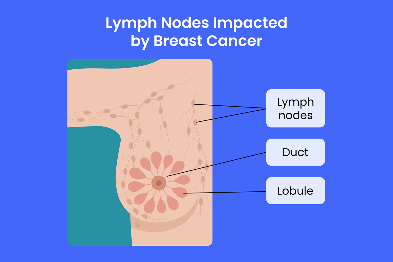 Breast Cancer in Lymph Nodes Symptoms, Causes, and Treatment