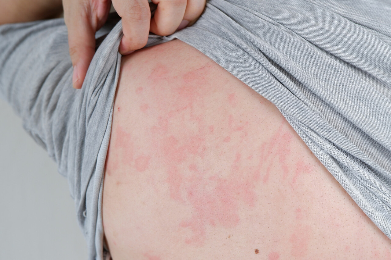 Hives while Breastfeeding: Treatment & Home Remedies