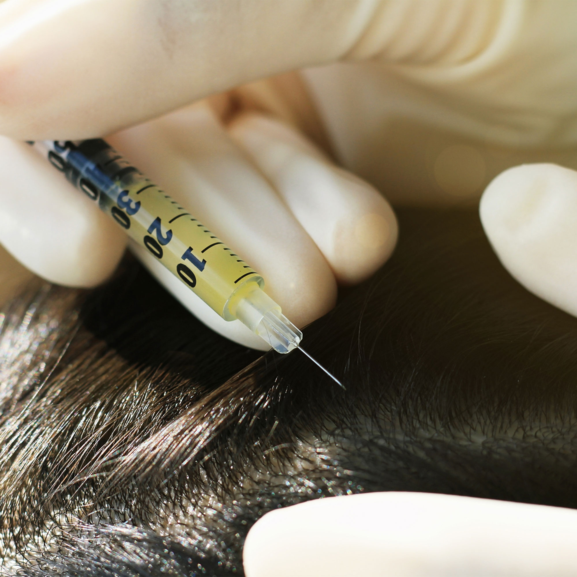 Is your hair loss happening due to steroids? | Dr Batra's™
