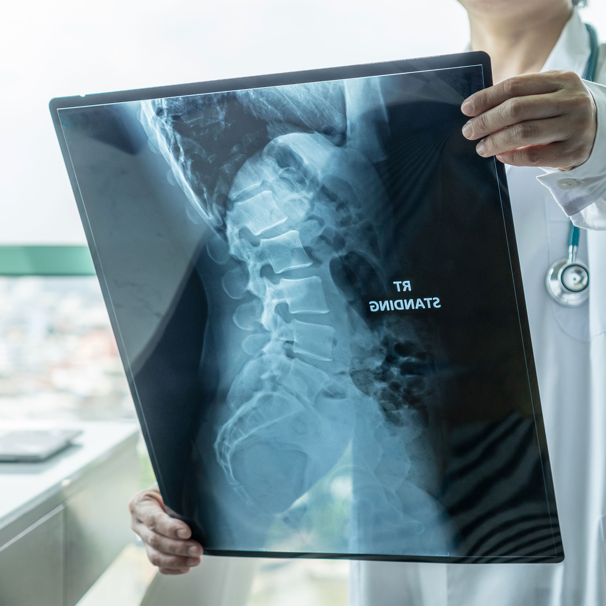 医生检查脊柱的X射线