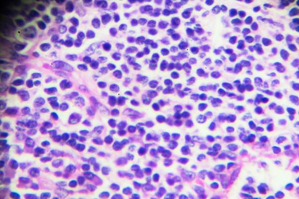 在显微镜下嗜酸性粒细胞的血细胞。