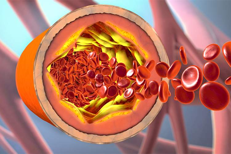 在动脉胆固醇的插图。