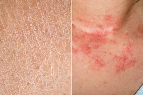 Eczema vs. Dry Skin: What's the Difference?