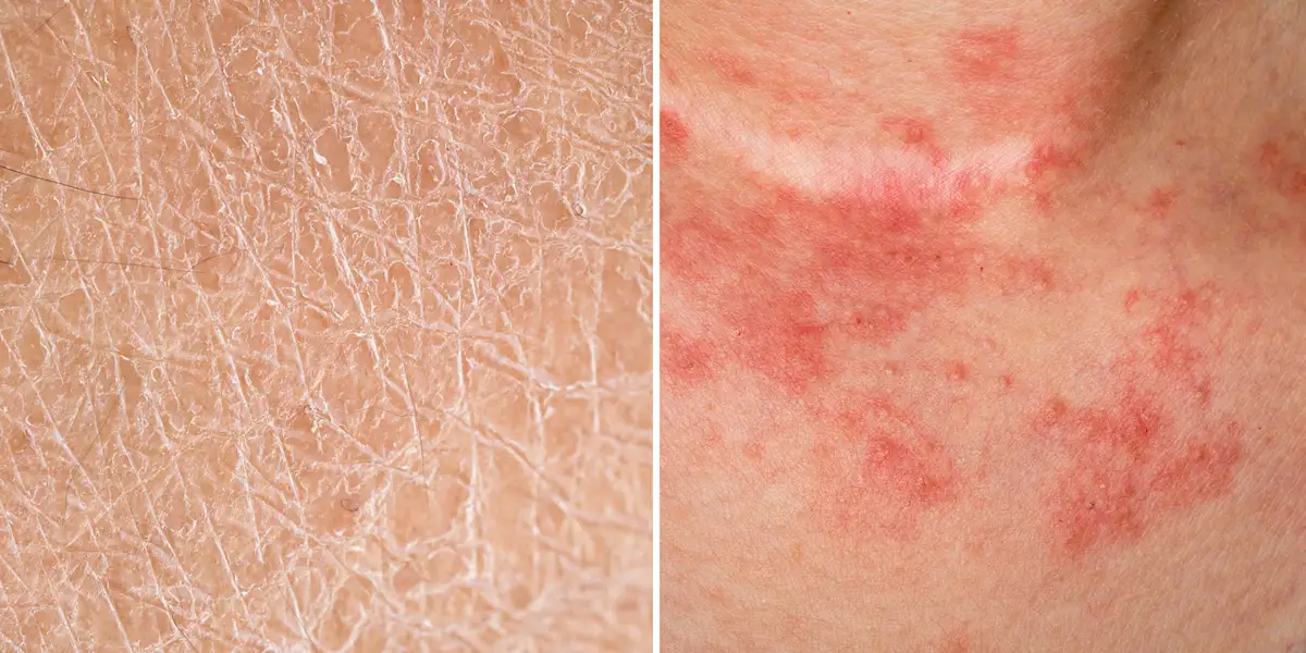 Eczema vs. Dry Skin: What's the Difference?