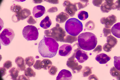 微观白血病细胞。