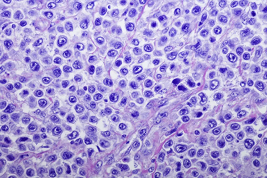 弥漫性大b细胞淋巴瘤。