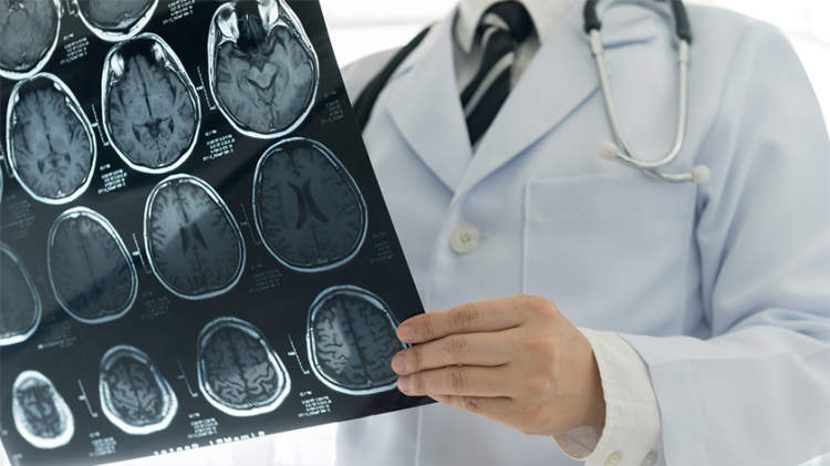 医生拿着脑部核磁共振成像扫描。