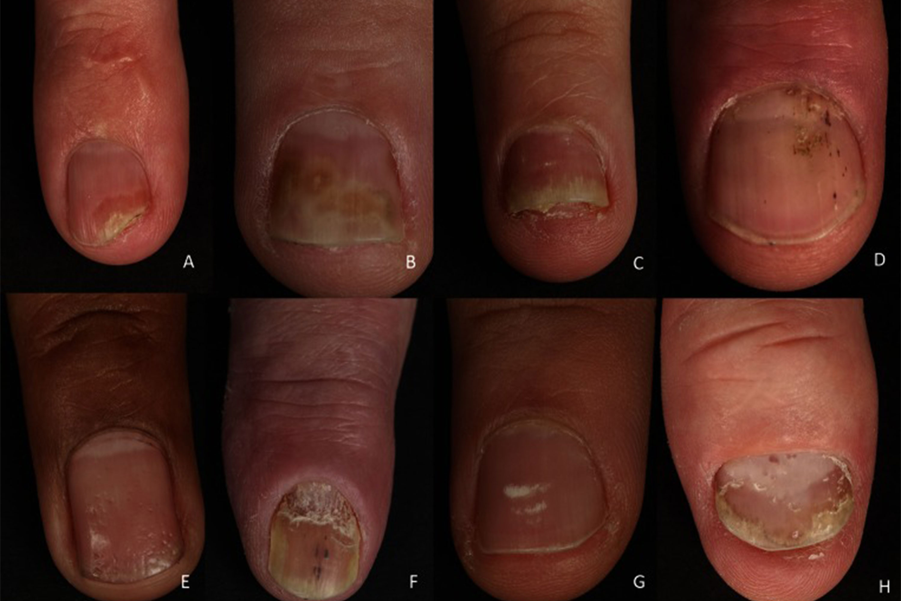 Latest Research in Nail Psoriasis | SpringerLink