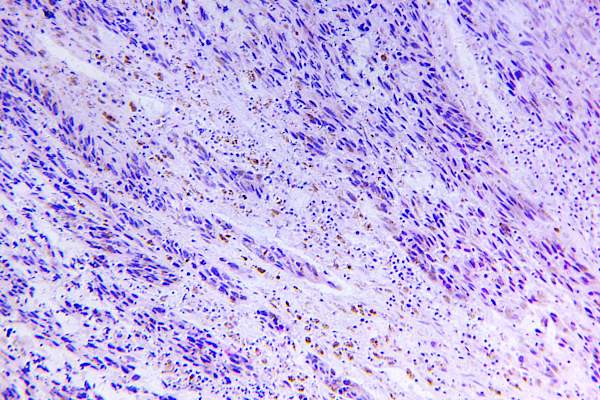 黑色素瘤的显微镜